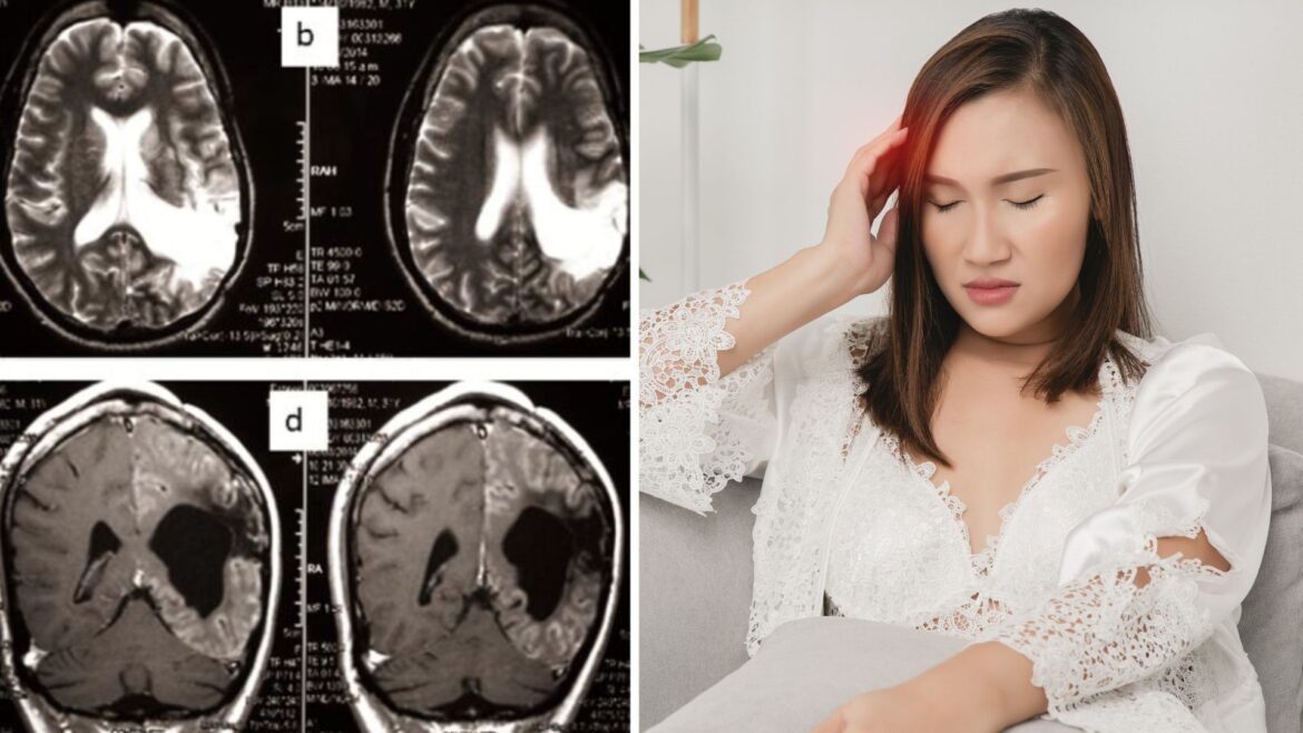 Migraña: El Dolor Invisible que Afecta la Vida Cotidiana y Desafía la Comprensión Social